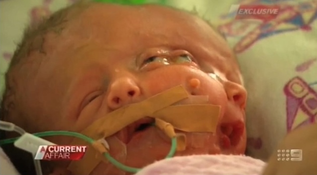 Woman Who Refused to Abort Conjoined Twins Sharing Same Head Gives Birth