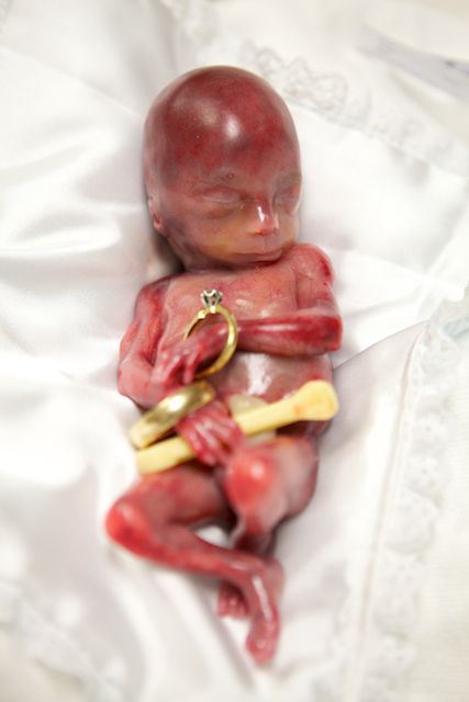 Photos of Baby Walter, Miscarried at 19 Weeks, Help Save ...