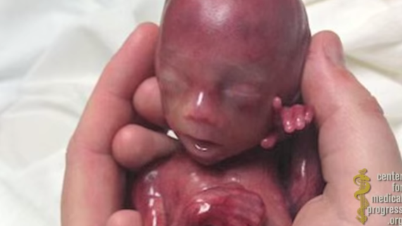 Seventh Planned Parenthood Expose’: Some Babies Are Alive When Organs Are Harvested