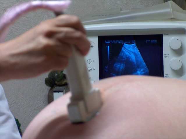 Now Sterile Mother Sues After Abortionist Leaves Baby’s Skull Bone Inside Womb During Dismemberment