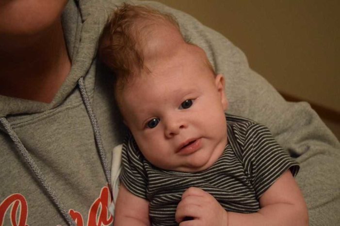 Baby Born With Brain Outside Skull Defies Odds After Parents Back Out of Abortion