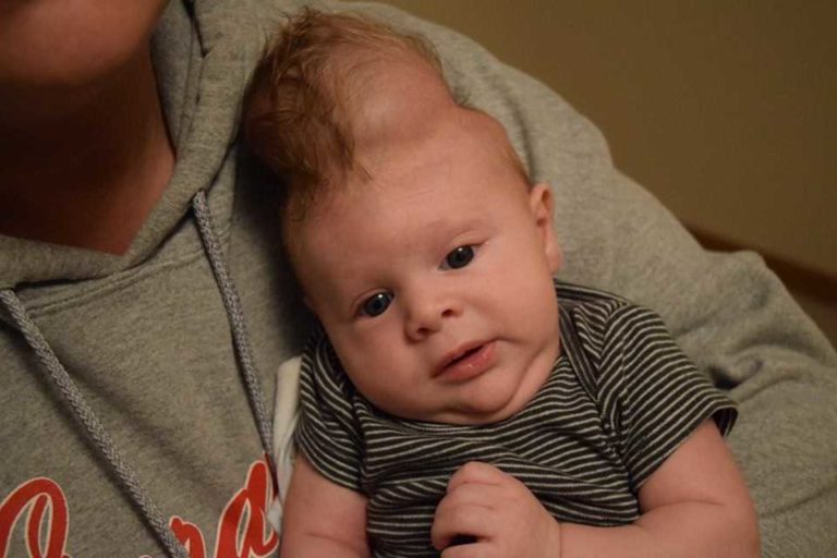 Baby Born With Brain Outside Skull Defies Odds After Parents Back Out ...