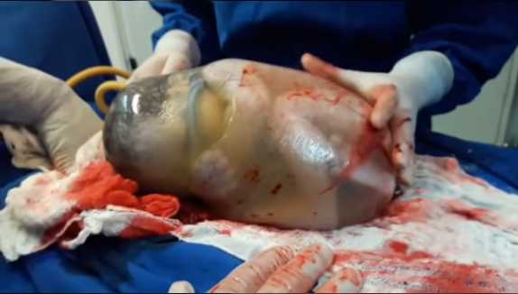 Fascinating Footage of Brazilian Baby Born Still in Amniotic Sac Goes Viral