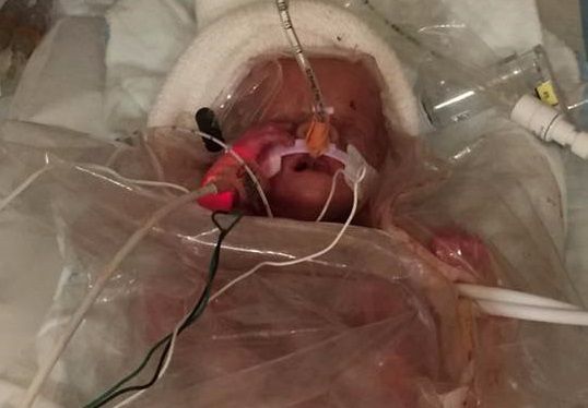 Doctors Successfully Deliver Baby From Mother With Aggressive Brain Cancer Who Laid Down Life for Unborn Daughter