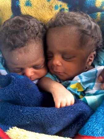 Conjoined Twins Saved Through Ministry’s Medical Flight