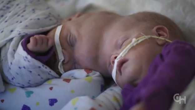 Conjoined Twins Who Survived One of World’s Rarest Surgeries Preparing to Go Home