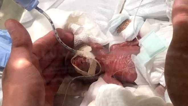 ‘Tiniest Baby Boy’ Leaves Tokyo Hospital
