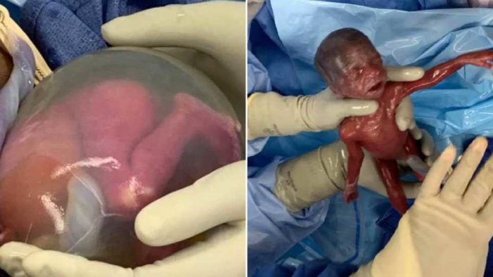 Astonishing Photos Show Birth of Second Most Premature Twin Babies Ever to Survive