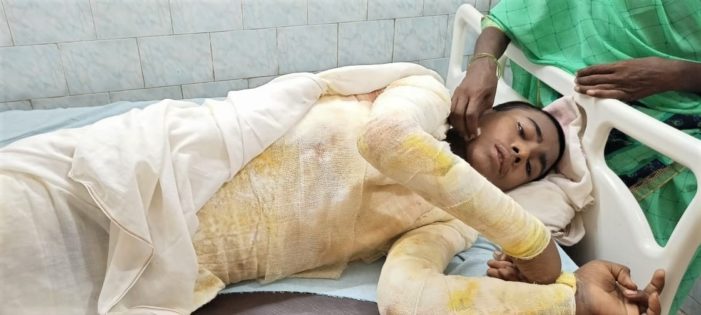 Christian Boy, 14, Clinging to Life after Burn Attack in Eastern India