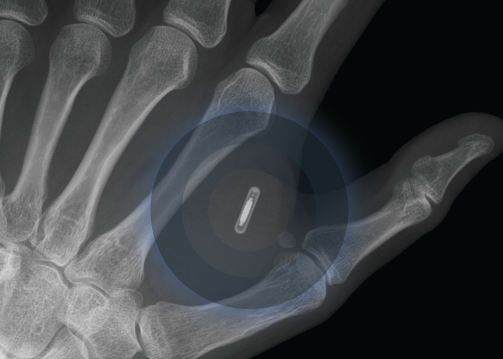 Implanted Microchip in Hand May Be Used to Verify COVID19 Vax Status