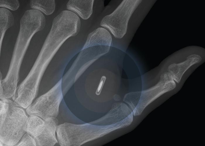 Implanted Microchip in Hand May Be Used to Verify COVID-19 Vax Status