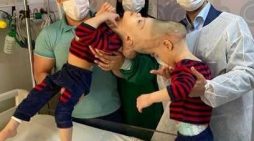 3-year-old twins with fused brains separated with help of VR